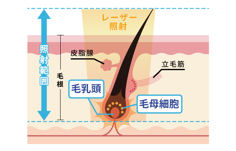 熱破壊式脱毛